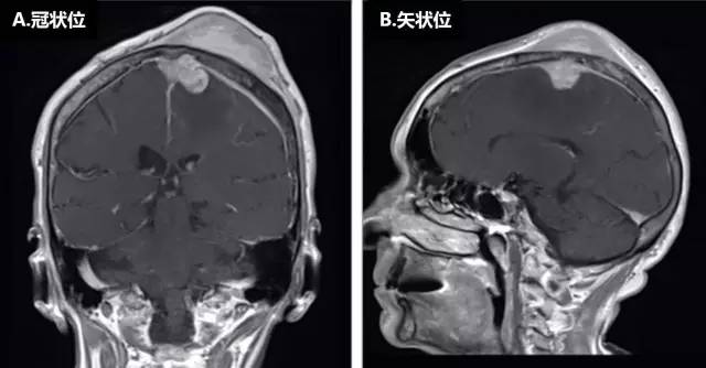 【病例】脑膜淋巴瘤1例MR 【病例】脑膜淋巴瘤1例MR