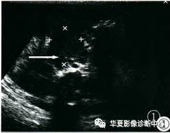 【病例】婴幼儿原发性胰腺内胚窦瘤1例 【病例】婴幼儿原发性胰腺内胚窦瘤1例