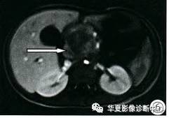 【病例】婴幼儿原发性胰腺内胚窦瘤1例 【病例】婴幼儿原发性胰腺内胚窦瘤1例
