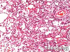 【病例】婴幼儿原发性胰腺内胚窦瘤1例 【病例】婴幼儿原发性胰腺内胚窦瘤1例