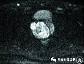 【病例】前列腺肉瘤1例MR 【病例】前列腺肉瘤1例MR