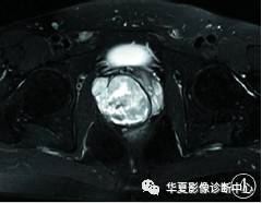 【病例】前列腺肉瘤1例MR 【病例】前列腺肉瘤1例MR