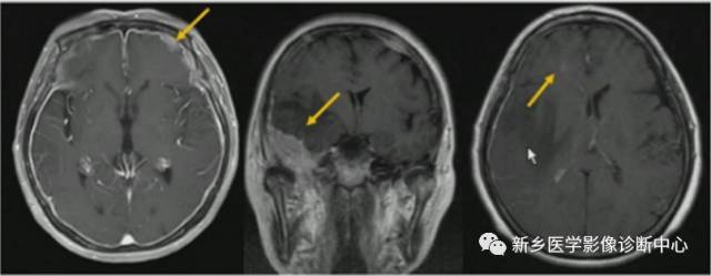 颅骨转移瘤影像分析 颅骨转移瘤影像分析
