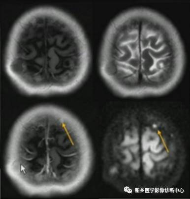 颅骨转移瘤影像分析