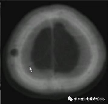 颅骨转移瘤影像分析 颅骨转移瘤影像分析