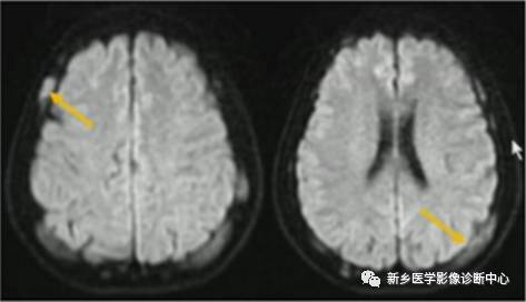 颅骨转移瘤影像分析 颅骨转移瘤影像分析