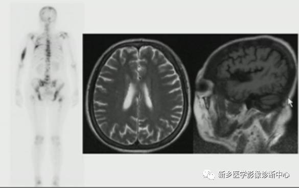 颅骨转移瘤影像分析 颅骨转移瘤影像分析