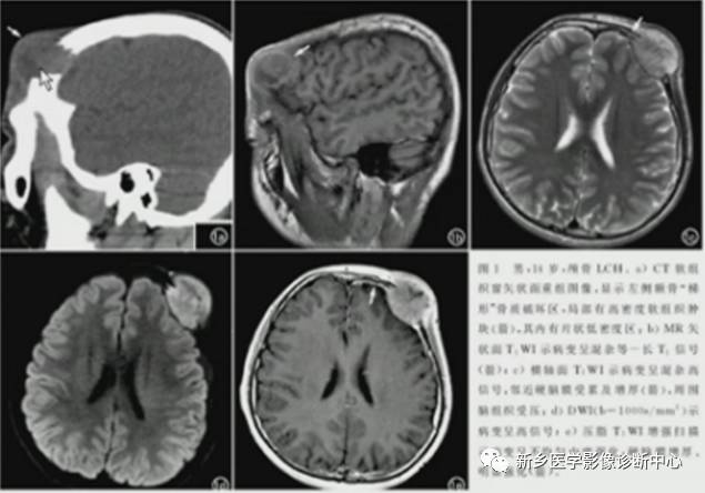 颅骨转移瘤影像分析 颅骨转移瘤影像分析