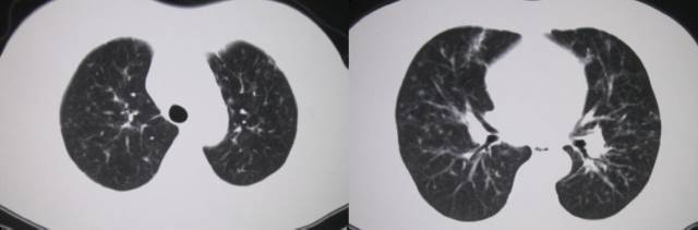 【病例】肺部结节病2例CT影像分析 【病例】肺部结节病2例CT影像分析