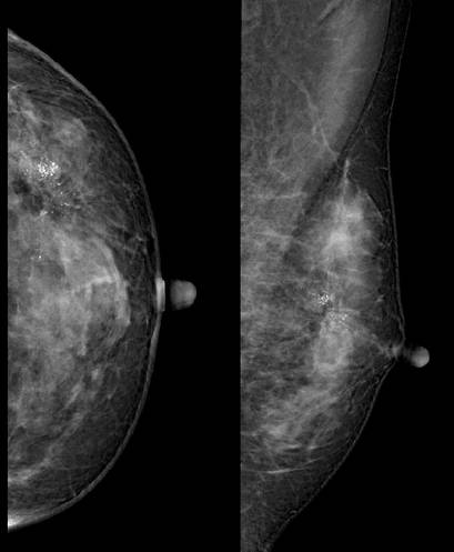 乳腺癌的影像学表现 乳腺癌的影像学表现