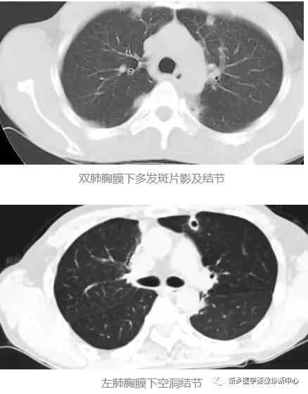 13种肺部罕见病变的影像学分析 13种肺部罕见病变的影像学分析