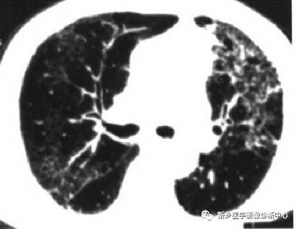 13种肺部罕见病变的影像学分析