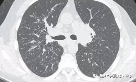 13种肺部罕见病变的影像学分析 13种肺部罕见病变的影像学分析