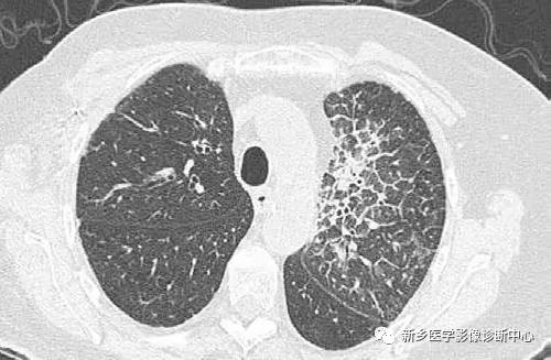 13种肺部罕见病变的影像学分析 13种肺部罕见病变的影像学分析