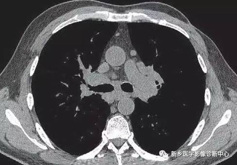 13种肺部罕见病变的影像学分析 13种肺部罕见病变的影像学分析