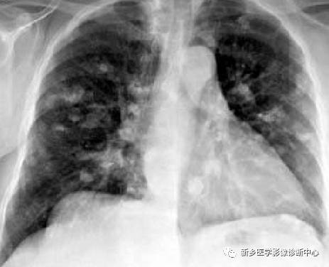 13种肺部罕见病变的影像学分析 13种肺部罕见病变的影像学分析