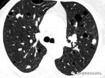 13种肺部罕见病变的影像学分析 13种肺部罕见病变的影像学分析