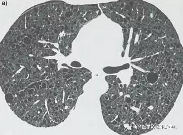 13种肺部罕见病变的影像学分析 13种肺部罕见病变的影像学分析