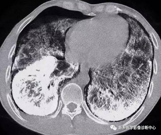 13种肺部罕见病变的影像学分析 13种肺部罕见病变的影像学分析