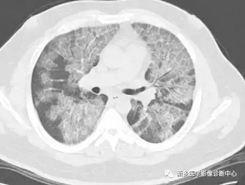 13种肺部罕见病变的影像学分析 13种肺部罕见病变的影像学分析