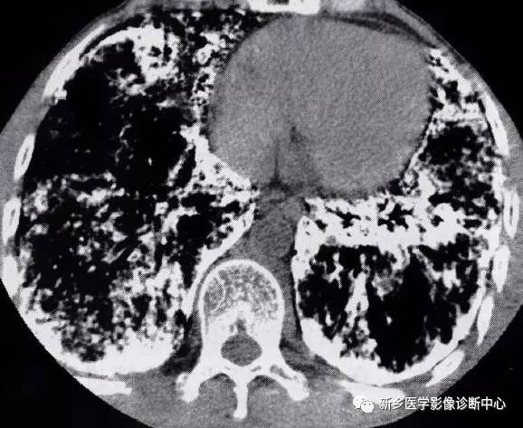 13种肺部罕见病变的影像学分析 13种肺部罕见病变的影像学分析