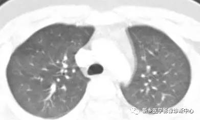 13种肺部罕见病变的影像学分析 13种肺部罕见病变的影像学分析
