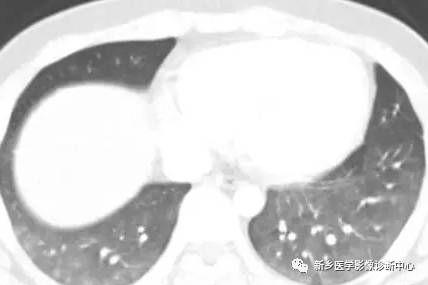 13种肺部罕见病变的影像学分析 13种肺部罕见病变的影像学分析