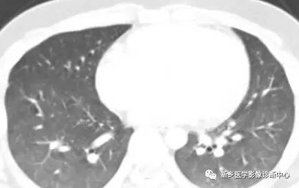 13种肺部罕见病变的影像学分析 13种肺部罕见病变的影像学分析