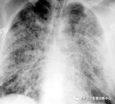 13种肺部罕见病变的影像学分析 13种肺部罕见病变的影像学分析