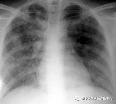 13种肺部罕见病变的影像学分析 13种肺部罕见病变的影像学分析