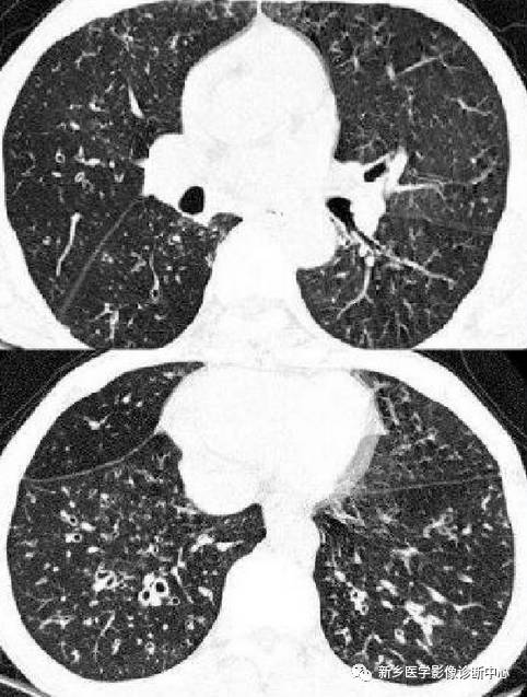 13种肺部罕见病变的影像学分析 13种肺部罕见病变的影像学分析
