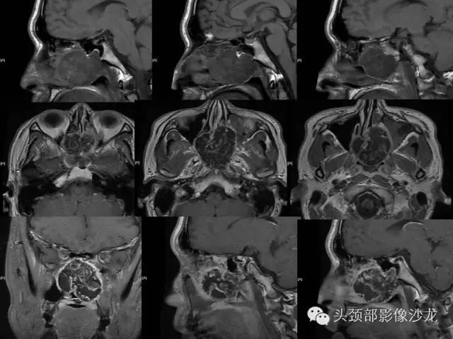 【病例】鼻腔软骨肉瘤1例CT及MR 【病例】鼻腔软骨肉瘤1例CT及MR