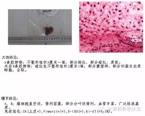 【病例】鼻腔软骨肉瘤1例CT及MR 【病例】鼻腔软骨肉瘤1例CT及MR