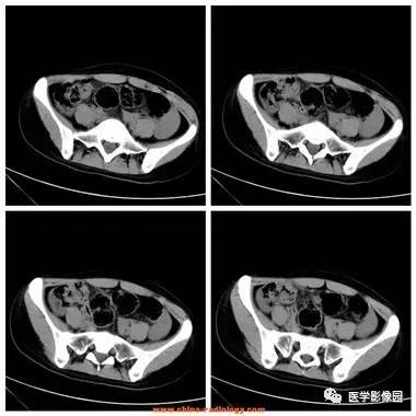 【病例】卵巢黄体囊肿破裂1例CT影像表现 【病例】卵巢黄体囊肿破裂1例CT影像表现