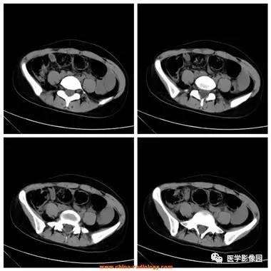 【病例】卵巢黄体囊肿破裂1例CT影像表现 【病例】卵巢黄体囊肿破裂1例CT影像表现