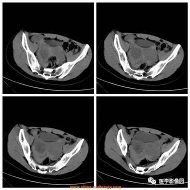 【病例】卵巢黄体囊肿破裂1例CT影像表现