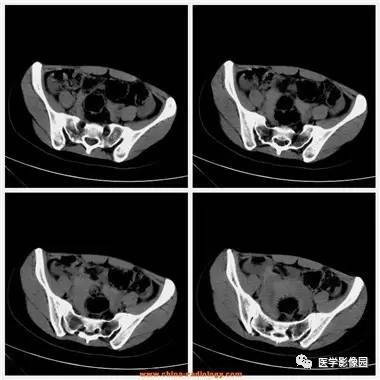 【病例】卵巢黄体囊肿破裂1例CT影像表现 【病例】卵巢黄体囊肿破裂1例CT影像表现