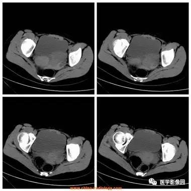 【病例】卵巢黄体囊肿破裂1例CT影像表现 【病例】卵巢黄体囊肿破裂1例CT影像表现