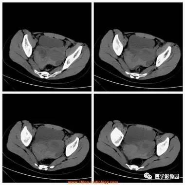 【病例】卵巢黄体囊肿破裂1例CT影像表现 【病例】卵巢黄体囊肿破裂1例CT影像表现