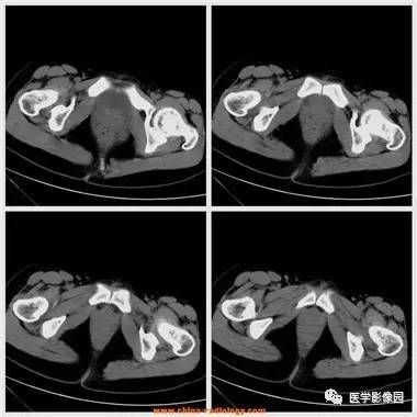【病例】卵巢黄体囊肿破裂1例CT影像表现 【病例】卵巢黄体囊肿破裂1例CT影像表现