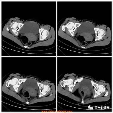 【病例】卵巢黄体囊肿破裂1例CT影像表现 【病例】卵巢黄体囊肿破裂1例CT影像表现