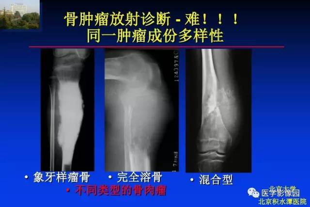 【PPT】骨肿瘤影像分析方法和诊断思路