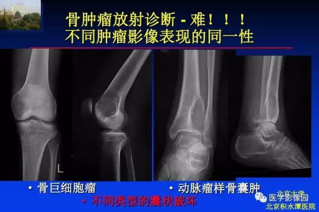 【PPT】骨肿瘤影像分析方法和诊断思路
