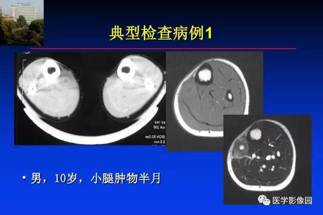 【PPT】骨肿瘤影像分析方法和诊断思路