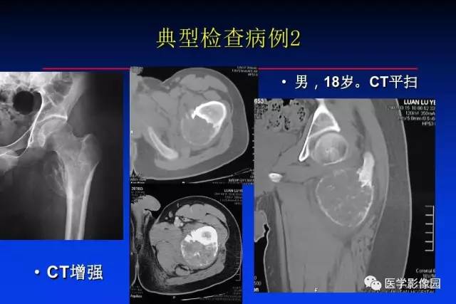 【PPT】骨肿瘤影像分析方法和诊断思路