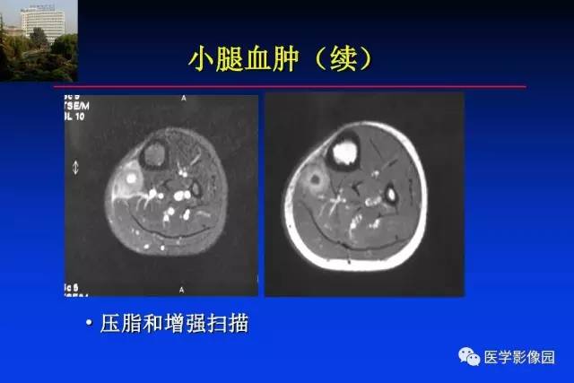 【PPT】骨肿瘤影像分析方法和诊断思路