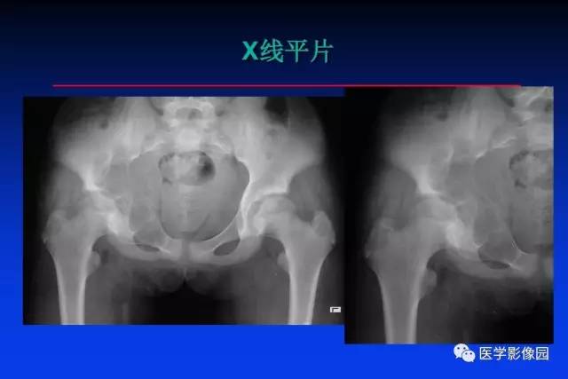 【PPT】骨肿瘤影像分析方法和诊断思路