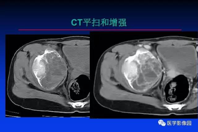 【PPT】骨肿瘤影像分析方法和诊断思路