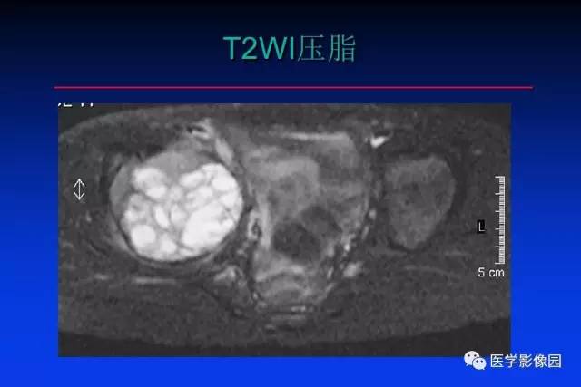 【PPT】骨肿瘤影像分析方法和诊断思路