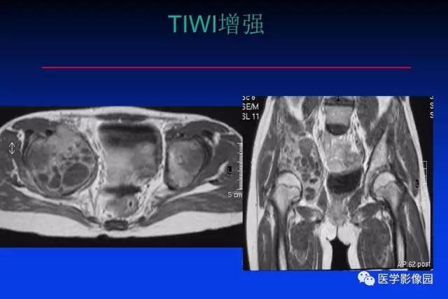 【PPT】骨肿瘤影像分析方法和诊断思路